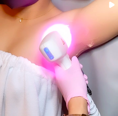 Alma Diode Laser Hair Removal
